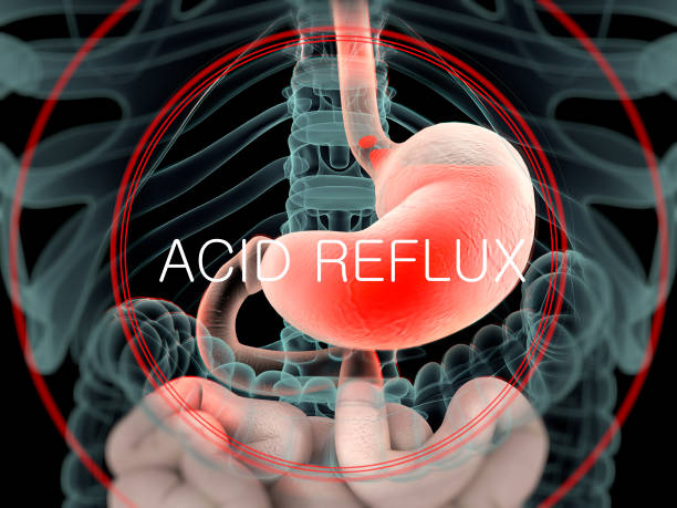 At Home Remedies For Acid Reflux